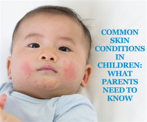 8 common skins conditions in kids: A parent’s guide .